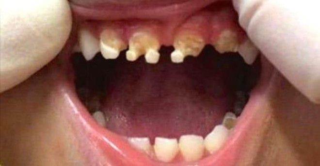 Когда врач увидел зубы 3летнего ребенка он задал матери всего один вопрос