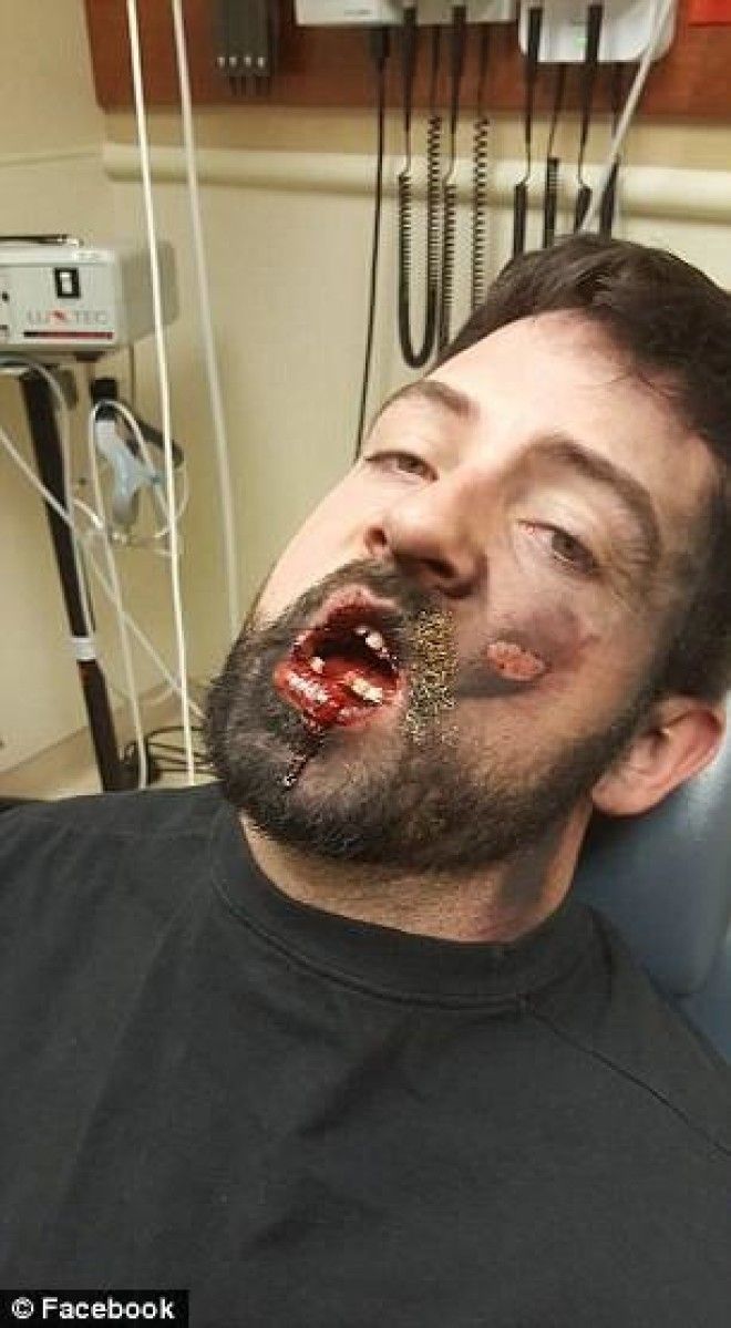 Взрыв электронной сигареты выбил ему 7 зубов и сжег лицо И таких жертв все больше