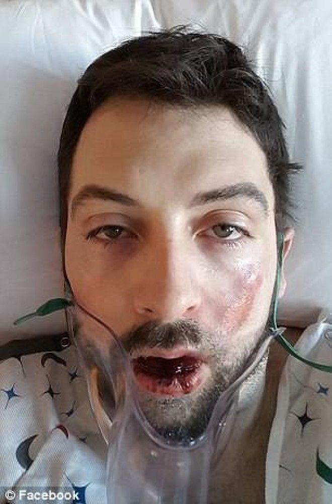 Взрыв электронной сигареты выбил ему 7 зубов и сжег лицо И таких жертв все больше