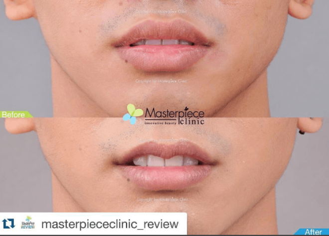 Новый тренд пластической хирургии уменьшение губ фото