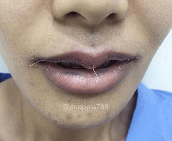 Новый тренд пластической хирургии уменьшение губ фото