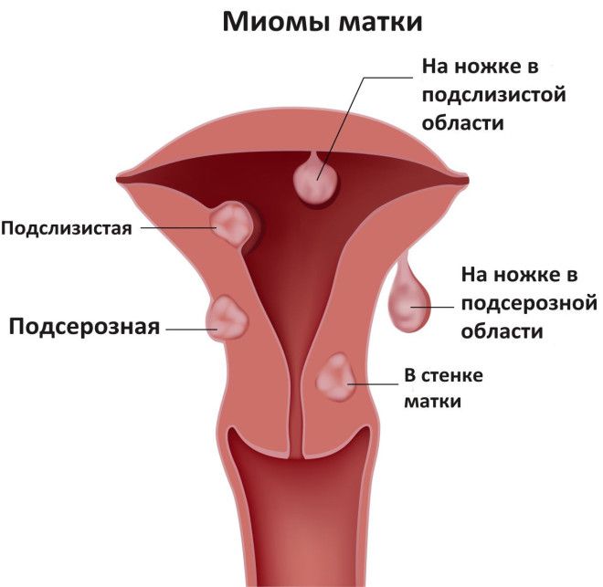 Гинекология женские болезни полипы