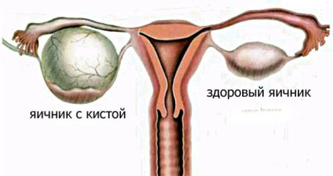 Основная причина гинекологических заболеваний у женщин