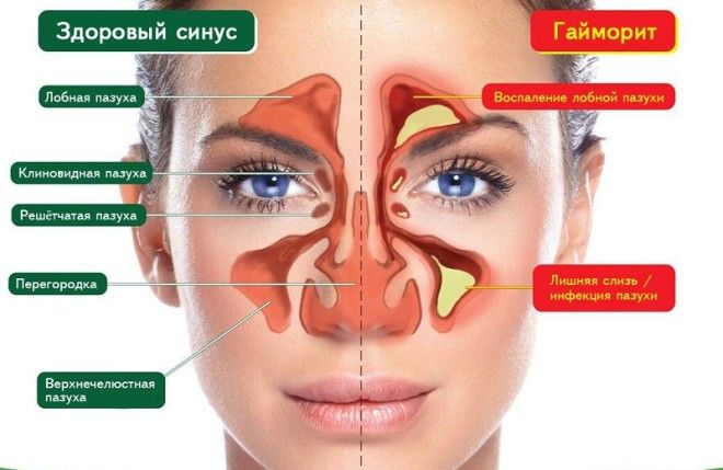 инфекция в гайморовых пазухах