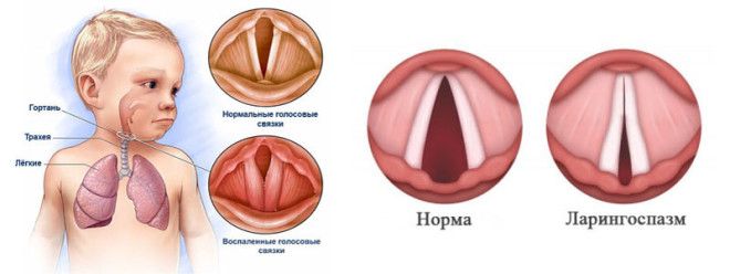 кашель у детей