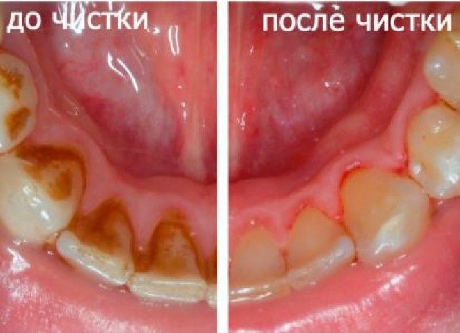 Вот крутой способ избавиться от зубного камня дома