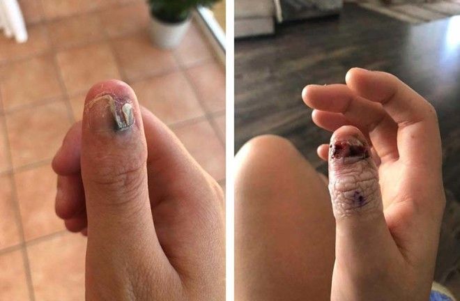 Ее привычка грызть ногти привела к ампутации пальца