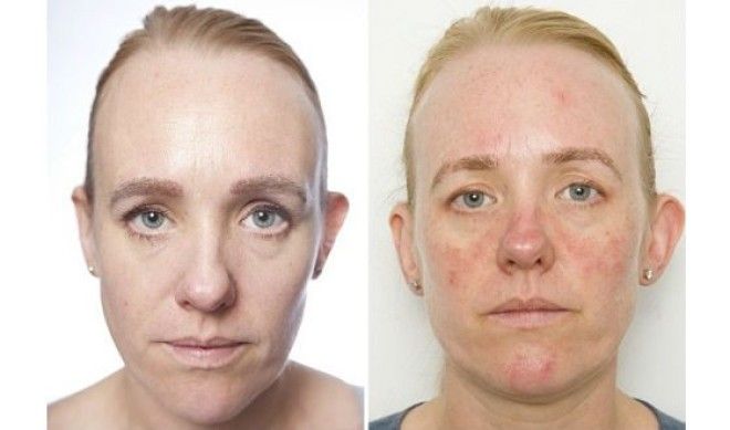 Результат шокирует Вот что будет с кожей лица если не умываться месяц
