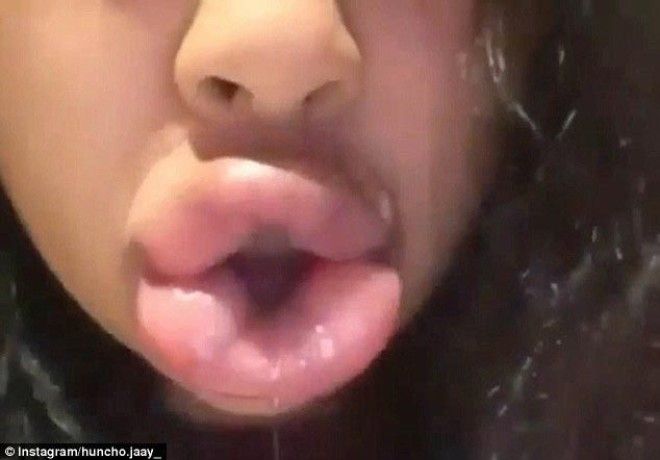 губы как у Кайли Дженнерkyliejennerchallenge экстремальное увеличение губ засовывают губы в маленькие баночки увеличение губ отек