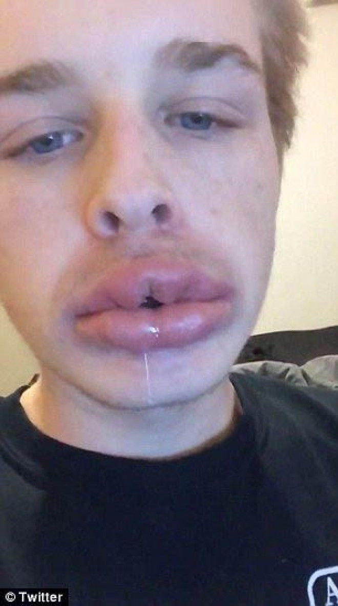 губы как у Кайли Дженнерkyliejennerchallenge экстремальное увеличение губ засовывают губы в маленькие баночки увеличение губ отек
