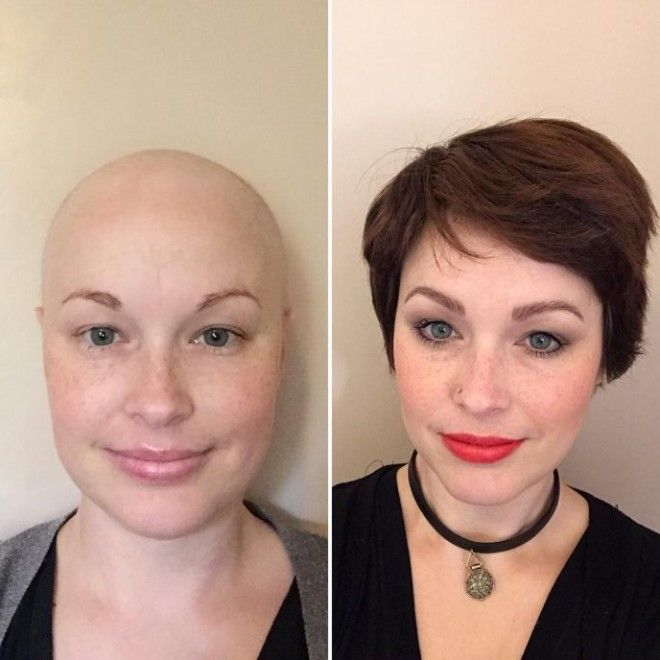 Душещипательные фотографии людей которые смогли победить рак