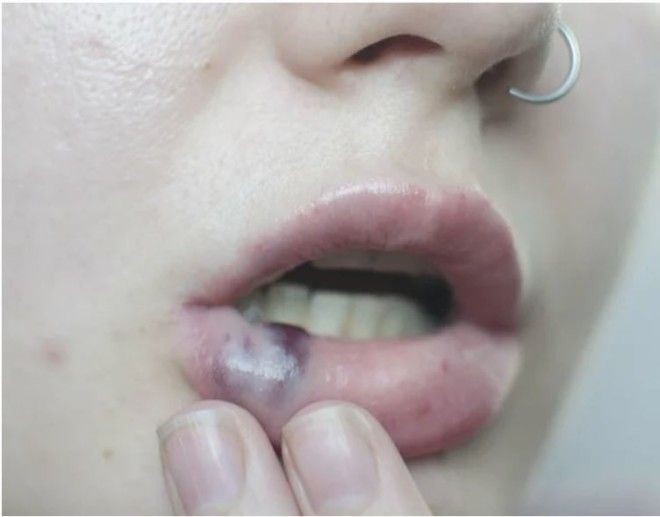 Фото для людей с железными нервами Последствия безобидного увеличения губ