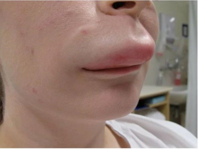 Фото для людей с железными нервами Последствия безобидного увеличения губ