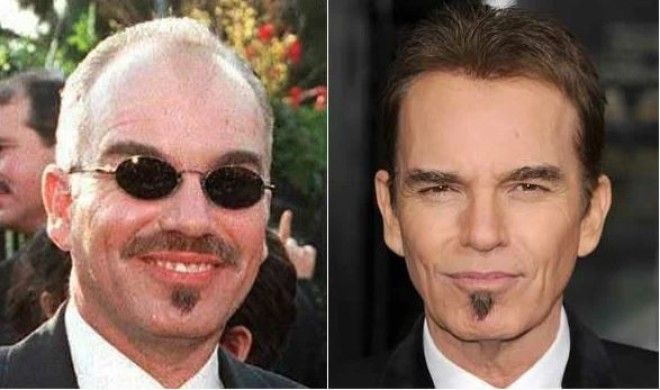 До и после Знаменитости которые сделали себе пересадку волос