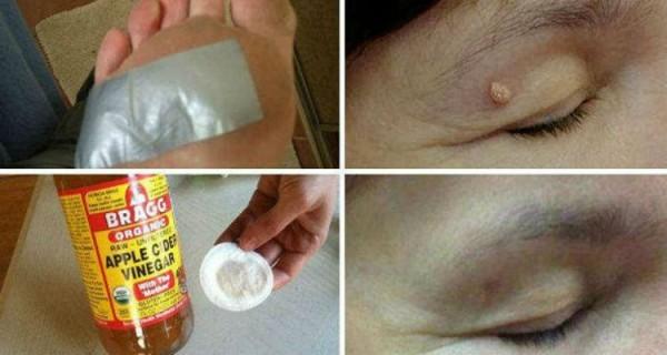 Это наиболее эффективное народное средство для лечения различных проблем кожи!