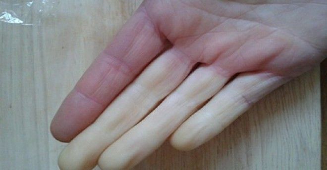 Почему ваши руки всегда холодные: 10 причин